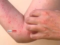 News Room : Chikungunya Alert: Health Officials Warn of Chikungunya Threat in Densely Populated Areas