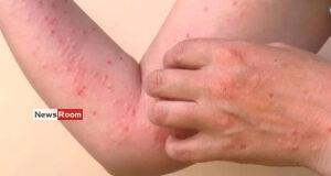 News Room : Chikungunya Alert: Health Officials Warn of Chikungunya Threat in Densely Populated Areas