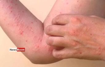 News Room : Chikungunya Alert: Health Officials Warn of Chikungunya Threat in Densely Populated Areas News Room Chikungunya Alert Health Officials Warn of Chikungunya