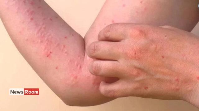 News Room : Chikungunya Alert: Health Officials Warn of Chikungunya