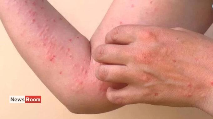 News Room : Chikungunya Alert: Health Officials Warn of Chikungunya Threat in Densely Populated Areas