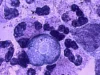 News Room Battling a rare brain eating disease in an.webp