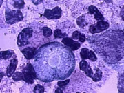 News Room : Battling a rare brain-eating disease in an Indian state News Room Battling a rare brain eating disease in an.webp