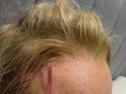 News Room Carrie Bickmore reveals grisly head wound as