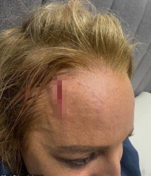 News Room Carrie Bickmore reveals grisly head wound as