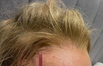 News Room Carrie Bickmore reveals grisly head wound as