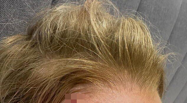 News Room Carrie Bickmore reveals grisly head wound as